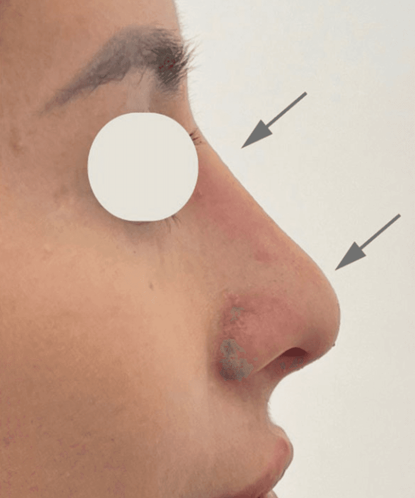 Nose contour aesthetic result documentation after