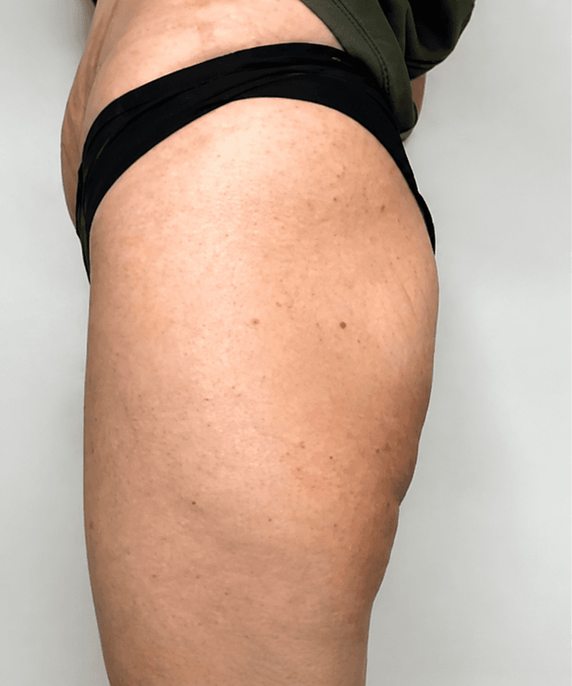 Body volumisation contour result documentation before