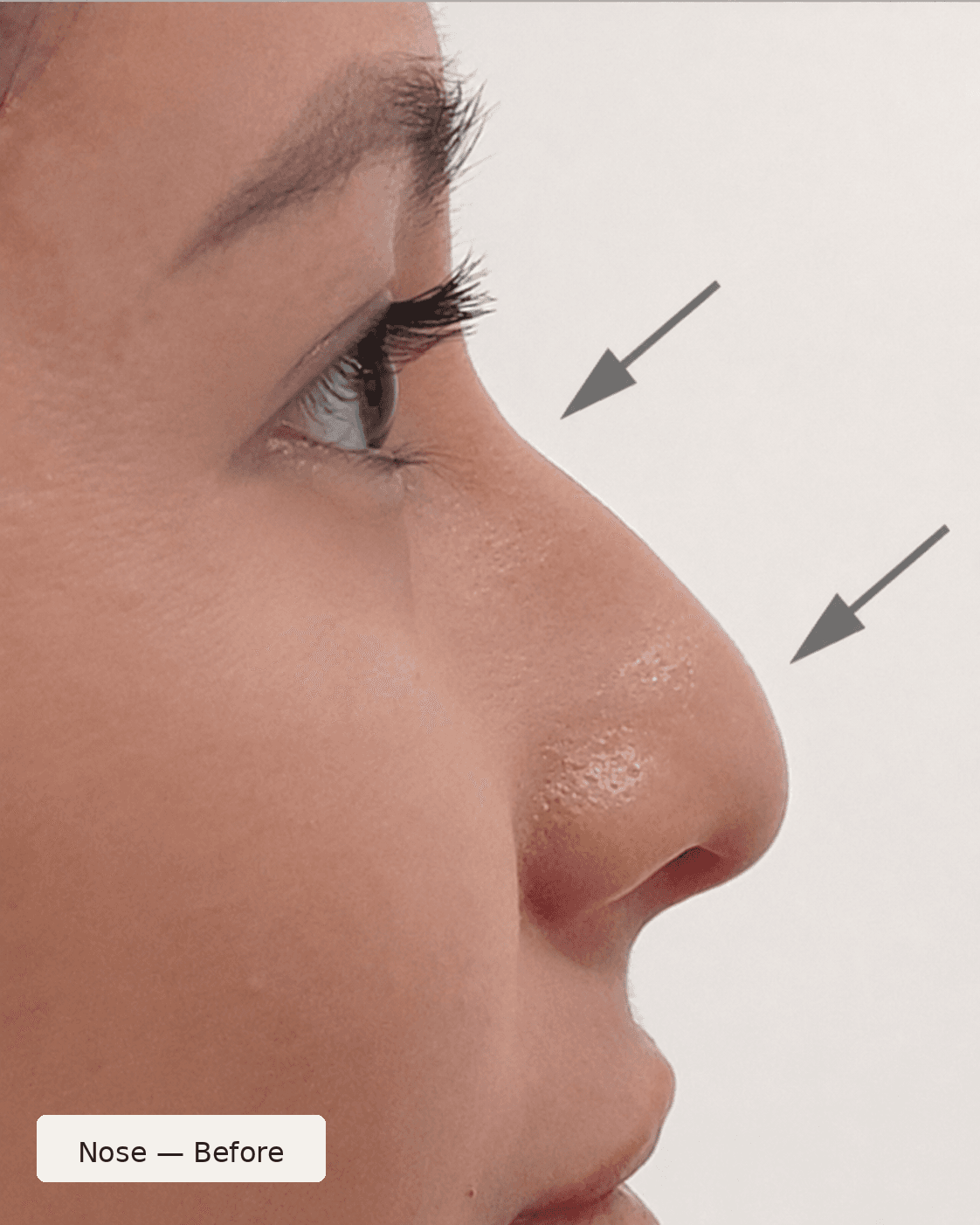 Nose Contour — Before