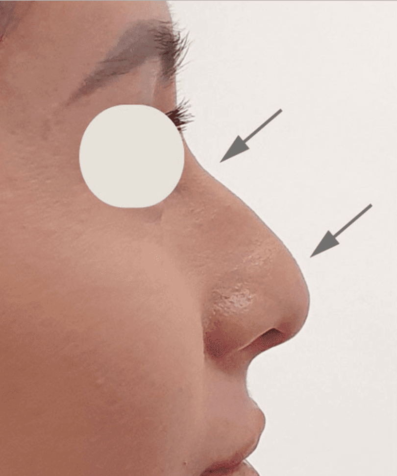 Nose contour aesthetic result documentation before