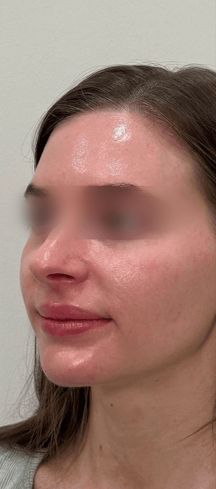 Under-Eye & Cheek Rejuvenation — After