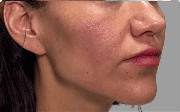 Jawline Contour — After