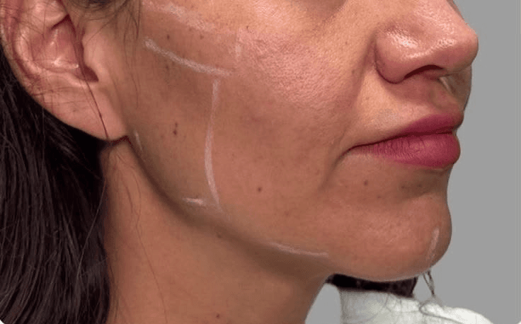 Jawline Contour — Before
