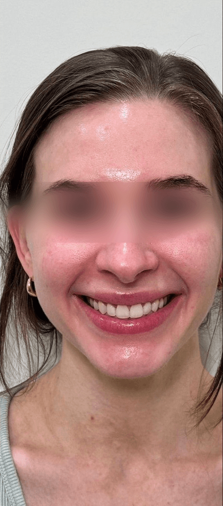 Skin Radiance — After