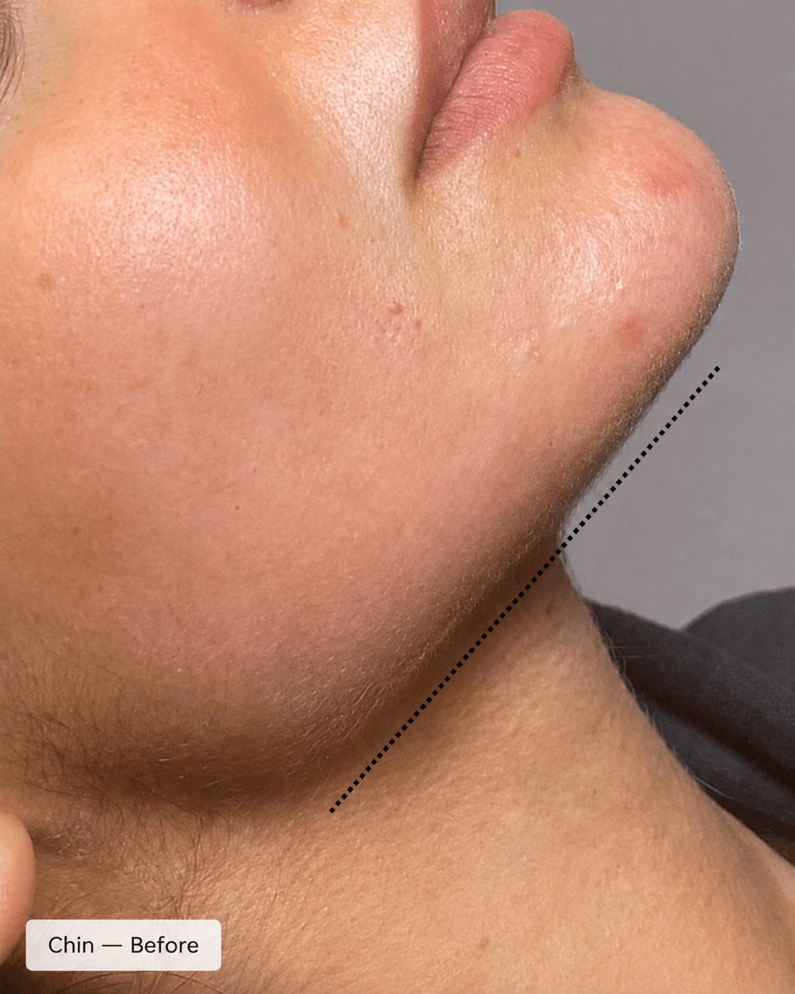 Chin Projection — After