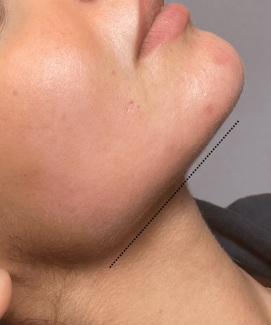 Chin contour aesthetic result documentation after