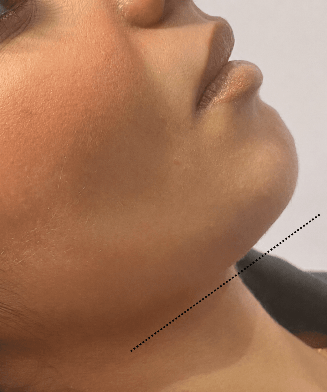 Chin contour aesthetic result documentation before